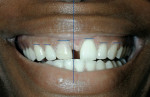 Figure 9  Unretracted view of the patient's smile showing that the existing dental midline is left of the patient's facial midline, and gingival zeniths are unsymmetrica