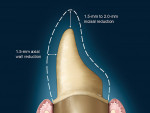 Figure 10  This diagram demonstrates the preparation requirements  for an anterior tooth.