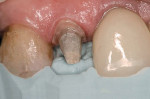 Figure 11  A silicone index in place allows the clinician to verify the amount of incisal reduction.