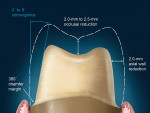 Figure 12  This diagram illustrates the preparation requirements for a posterior tooth.