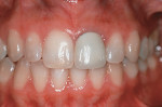 Figure 1  Preoperative view of a crown restoration to be replaced on the left central incisor.