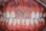 Figure 3  Preoperative view of the central incisors prior to placement of porcelain veneers.