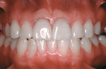 Figure 4  View of the porcelain veneers on the maxillary central incisors displaying chronic inflammation at the one-year recall (veneers created by Steve McGowan, CDT).