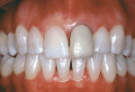 Figure 5  Preoperative view of a crown restoration to be replaced on the left central incisor.