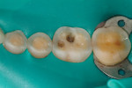 Figure 1  Representative photographs of: tooth preparation for posterior ceramic onlay restorations without buccal veneer (Fig 1) and with buccal veneer (Fig 2); occlusal view of posterior teeth restored with ceramic onlay restorations without buccal