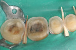 Figure 2  Representative photographs of: tooth preparation for posterior ceramic onlay restorations without buccal veneer (Fig 1) and with buccal veneer (Fig 2); occlusal view of posterior teeth restored with ceramic onlay restorations without buccal