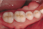 Figure 4  Representative photographs of: tooth preparation for posterior ceramic onlay restorations without buccal veneer (Fig 1) and with buccal veneer (Fig 2); occlusal view of posterior teeth restored with ceramic onlay restorations without buccal