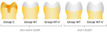 Figure 6  Schematic representative of the preparation designs evaluated: group C—a MOD gold onlay restoration; groups NT and WT—a 2-mm occlusal reduction maintaining cusp steepness of 45 degrees relative to the occlusal surface; groups NT-V and W