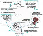 Figure 1  Mechanism of hypercontraction. Reprinted with permission: Kerstein RB. A comparison of traditional occlusal equilibration and immediate complete anterior guidance development. <em>Cranio.</em> 1993;11(2):126-140.