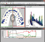 Figure 2 Digital diagnostic technologies measured and visually displayed the areas of improper dental forces that required attention.