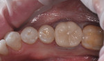 Figure 17 The restoration turned a natural tooth color, and was placed into the patientâ€™s mouth with a fourth-generation bonding agent and resin cement.