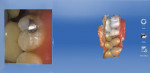 Figure 6 The preparation after the opposing maxillary quadrant was captured.