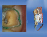 Figure 5 The preparation after the opposing maxillary quadrant was captured.