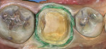 Figure 2 Retraction and hemostasis was achieved and the tooth was prepared.