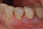 Figure 3 The gingival tissue following rinsing of the retraction paste.