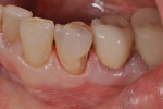 Figure 4 Note the good gingival retraction; the tissue has not been traumatized and a clean, dry field is present.