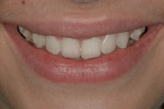 Figure 10  ”E” photograph with mockup in the mouth, checking size, shapes, and esthetics.