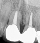 Figure 1 (Case 1) Pre-treatment radiograph showing external root resorption.