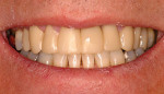 Figure 5 Photograph of the temporaries from the dentist’s wax-up.