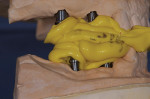 Figure 2 An untouched bite record was seated on upper and lower casts with implant bite posts in place.
