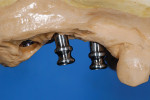 Figure 12 Casts were made and bite posts were placed using light finger pressure.