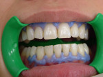 Fugure 5 Resin barrier applied to maxillary and mandibular arches.