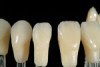 Fig 19. Patient’s smile with monolithic solid zirconia prosthesis (no cutback for porcelain).