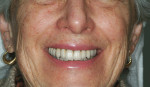 Figure 2  This patient"s smile view showed complete fixed upper porcelain-fused-to-metal (PFM) dental restorations with DM approximately centered to Cupid"s Bow. The full-face smile view revealed a significant discrepancy between DM and FM.