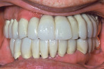 Figure 7  New complete upper and lower fixed composite-fused-to-gold dental restorations for this patient with DH in harmony with FH.