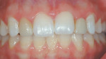 Figure 9  This patient sought treatment for color correction of her maxillary lateral incisors. The right lateral incisor was a porcelain veneer and the left one was the pontic of an all-ceramic, resin-bonded bridge, which</span> had debonded on nume