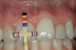 Figure 11  The Proportion Gauge was used to analyze tooth proportion, revealing the need for crown lengthening of the right central incisor to achieve a naturally attractive proportion of 78% width to length. It was decided that treatment would be ac