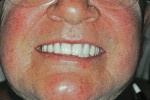 Figure 17  This patient displayed lower lip asymmetry. The recommendation of Check Point 5 is to follow the FH in such a situation, as presented here. A dental composition that follows a symmetrical lower lip contour can be seen again in Figure 15.