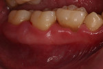 Figure 5  Retained primary dentition is common among those with T21 as seen here.