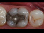 Figure 1  Preexisting clinical condition of a mandibular molar to be restored.