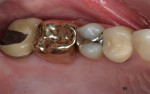Figure 3  Preexisting clinical condition of a maxillary posterior quadrant to be restored. (Clinical dentistry by Michael Sesemann, DDS.)