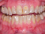 Figure 5  Preexisting clinical condition of maxillary anterior teeth to be restored.