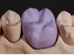 Figure 12  A milled e.max full-contour posterior restoration, shown in the 