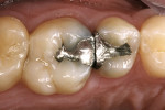 Figure 1  Preoperative clinical condition of tooth No. 3 with recurrent caries under the mesiofacial cusp.