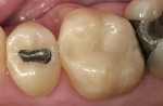 Figure 7  Baseline evaluation of tooth No. 3 with a Paradigm MZ100 composite chairside CAD/CAM inlay.