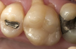 Figure 9  Six-year evaluation of the Paradigm MZ100 inlay on tooth No. 3.