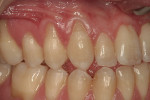 Figure  2  Maxillary right side view reveals Miller Class I recession on teeth Nos. 4 to 6, Miller Class II recession over tooth No. 3, and a lack of minimal keratinized tissue over teeth Nos. 3 and 5.
