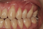 Figure  4  Maxillary left side view reveals Miller Class I recession on teeth Nos. 11 to 13 and Miller Class II recession over tooth No. 14. There is a lack of adequate keratinized gingiva over teeth Nos. 11 and 14.