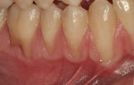 Figure  5  The lower right side view shows Class I recession from teeth Nos. 27 to 30 and minimal keratinized tissue over the same teeth.