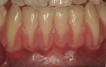 Figure  6  Miller Class I recession and lack of keratinized gingiva evident on teeth Nos. 22 to 27.