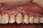 Figure  9  First connective tissue grafting surgery for teeth Nos. 9 to 14 (July 2005). The aim was not only to correct recession defects but also to convert the biotype from thin to thick. The final closure with 4-0 ePTFE is depicted here with prima