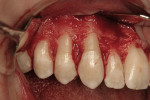 Figure  10   Second CTG surgery for teeth Nos. 3 to 8 (July 2006). Significant Nos. 5 and 6 root prominences exist. Notice the normal alveolar crest to cementoenamel junction relationship on teeth Nos. 7 and 8.