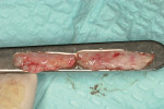 Figure  13  Third CTG surgery for teeth Nos. 21 to 28 (May 2007). Bilateral palatal grafts, comprising a total dimension of 50 mm by 7 mm, were harvested and trimmed to conform to the recession defects.