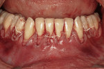 Figure  16  Initial flap positioning over the grafts. Notice the uncovered areas at the midlabial of the anterior teeth.