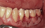 Figure  18  Fourth CTG surgery for teeth Nos. 19, 20, 29, and 30 (May 2008). The connective tissue graft sutured in place over teeth Nos. 19 and 20. Grafts on the right and left sides were treated with plasma rich in growth factors, which does not al