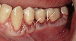 Figure  19  The flap was coronally advanced to cover the Nos. 19 and 20 graft.